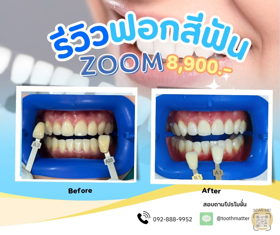 ภาพรีวิวจริงก่อนและหลังฟอกสีฟัน Zoom ที่ Tooth Matter
