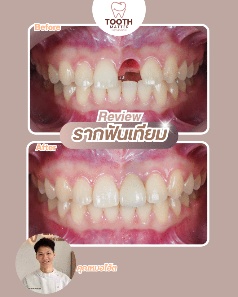Before และ After เคสรากฟันเทียมบริเวณฟันหน้า จาก Tooth Matter