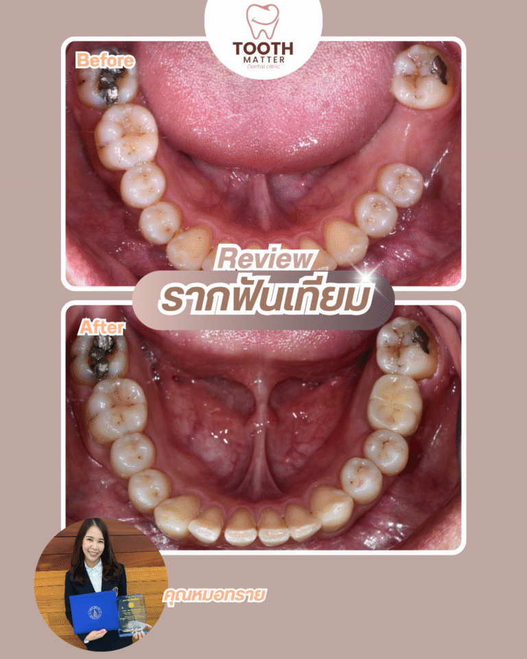 Before และ After เคสรากฟันเทียมบริเวณฟันกราม จาก Tooth Matter