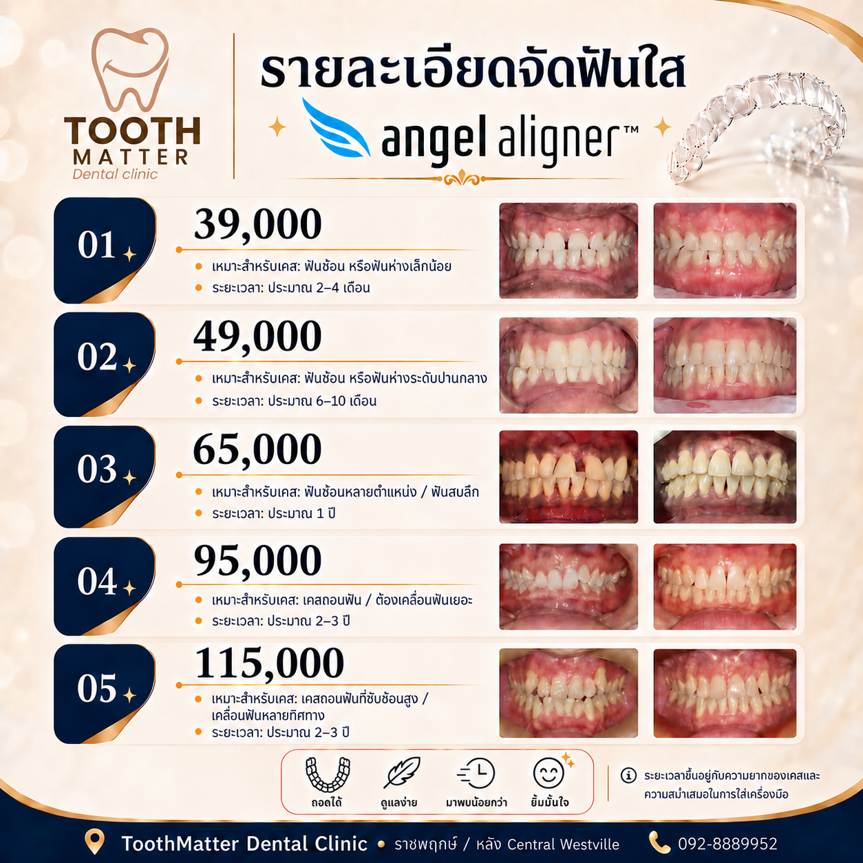 ราคา Angel Aligner 5 แพ็กเกจ 39,000 / 49,000 / 65,000 / 95,000 / 115,000 บาท